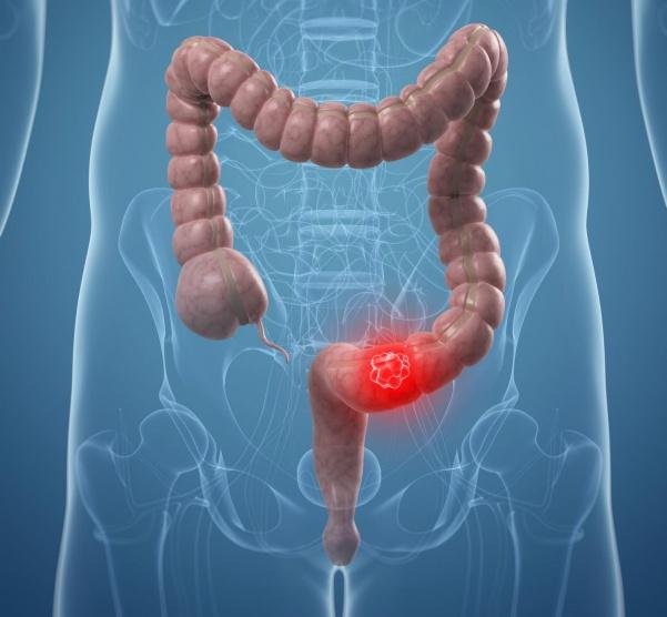أطباء يكشفون 4 أعراض للإصابة بسرطان الأمعاء