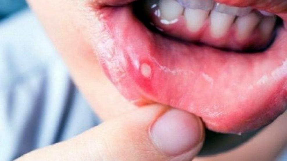 ‫كيف تتجنب الإصابة بقرحة الفم‬؟