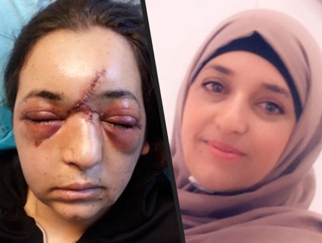 هآرتس: جندي إسرائيلي تسبب بكسر جمجمة سيدة في العيسوية