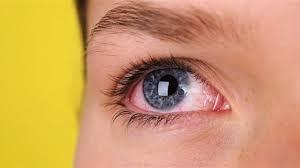 ما أسباب ‫الأكياس الدمعية في العين؟