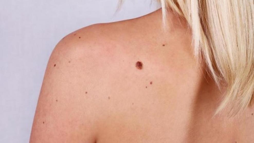متى تصبح الشامة والنمش من أعراض سرطان الجلد؟