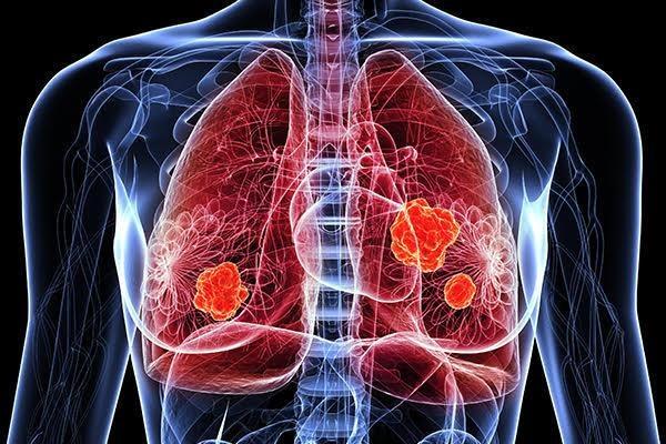الصين توفر عقارا طبيا مُطوّرا محليا لمرضى سرطان الرئة