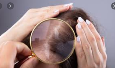 ماهي أسباب تساقط الشعر و ما علاجه ؟