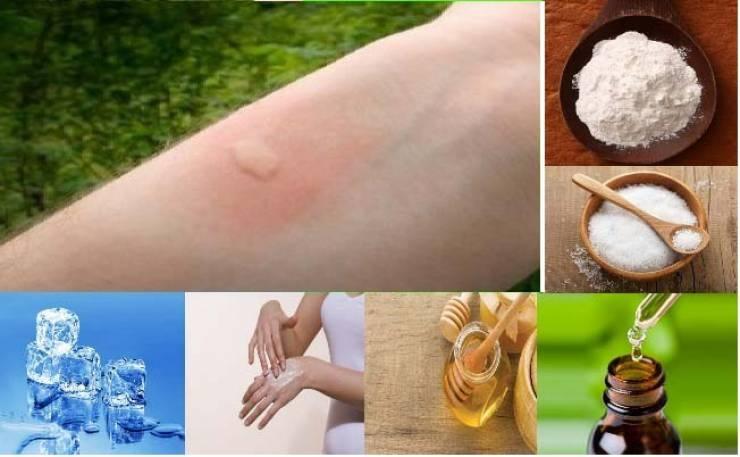 كيف تريح نفسك من لسعة البعوض فورا