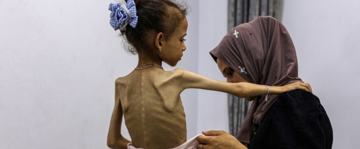 3 وفيات نتيجة التجويع بغزة خلال يوم لترتفع الحصيلة لـ 428