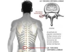 اصابة نيمار يوم أمس ينهي مشواره في المونديال