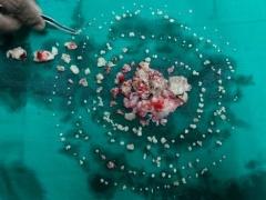 أطباء يقتلعون أكثر من 200 سن من فم فتاة هندية