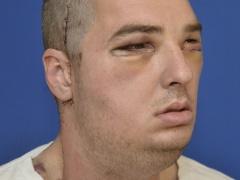 أمريكي يخضع لعملية زرع وجه جديد بعد 30 عملية فاشلة