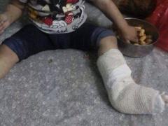 صورة- في نابلس..طفلةٌ كُسرت قدمها اليسرى وجبر الأطباء رجلها اليمنى