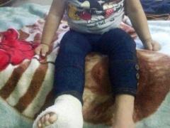 صورة- في نابلس..طفلةٌ كُسرت قدمها اليسرى وجبر الأطباء رجلها اليمنى