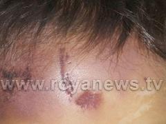 بالصور: آثار الضرب والاعتداء الذي تعرضت له 