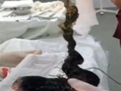 صور| إزالة شعر يزن أكثر من كيلو جرام من معدة طفلة!!