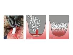 حقنة يُمكنها غلق جروح الطلقات النارية في ثوان - فيديو