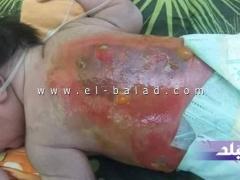 بالصور| احتراق طفل رضيع داخل حضانة بالإسكندرية