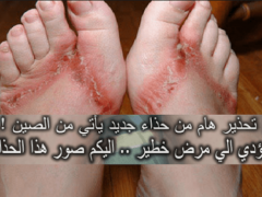 صورة| تحذير من حذاء خطير يأتي من الصين ويسبب مرض خطير!