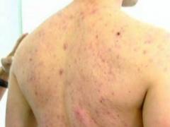 كيف نعالج بثور الظهر ونتجنب آثارها؟!