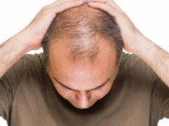 تساقط الشعر .. الأسباب الأكثر أهمية