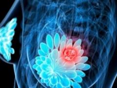 علاج يحمي النساء من سرطان الثدي تكلفته 1.5 دولار شهرياً