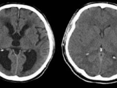 هذه أسباب 'استسقاء' الرأس عند المواليد الجدد!