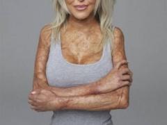 أُحرقت بسبب جمالها!