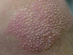 صور| 'جلد الدجاج'.. 7 طرق لمعالجة هذا المرض!