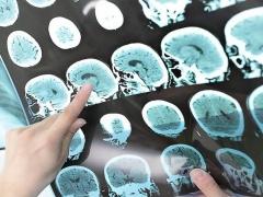 اكتشاف فيروس قادر على علاج سرطان الدماغ