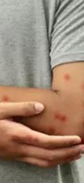 نيويورك تؤكد أول إصابة بسلالة 