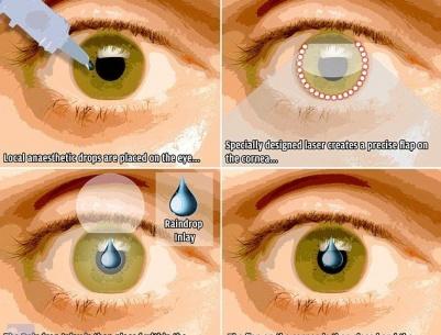 جهاز جديد في العين يغنيك عن نظارات القراءة