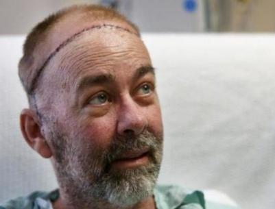 نجاح أول عملية لزراعة جمجمة وفروة رأس