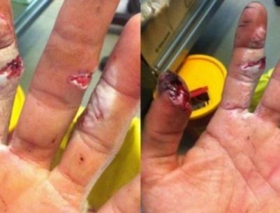 بسبب إضراب أطباء ‫‏مستشفى رفيديا‬ ضاع إصبعي