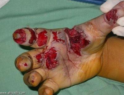 الصحة تدعو إلى عدم استخدام المفرقعات باحتفالات التوجيهي