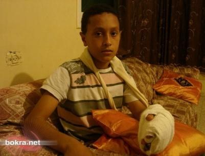 الجليل- بتر أصابع طفل كان يلهو بالمفرقعات