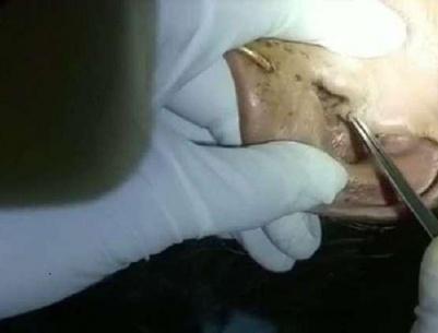 استخراج 30 يرقة حية من أذن مسنة!