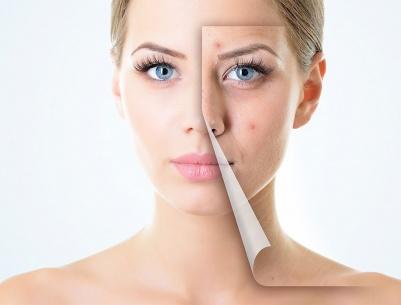 احذروا.. هذه الأطعمة تسبب “حب الشباب”