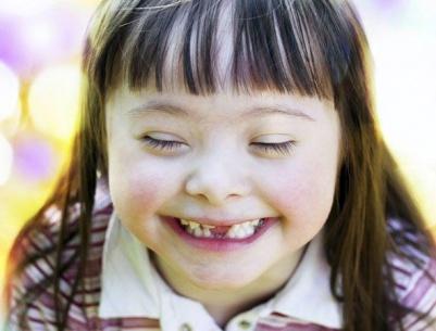 دراسة تبعث الأمل لإيجاد علاج شخصي لمرضى متلازمة داون