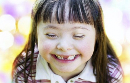 دراسة تبعث الأمل لإيجاد علاج شخصي لمرضى متلازمة داون