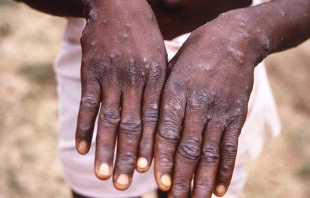 جدري القردة يقلق إفريقيا.. طوارئ صحية واللقاح غير متوفر