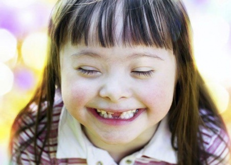 دراسة تبعث الأمل لإيجاد علاج شخصي لمرضى متلازمة داون