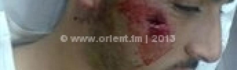 اصابة شاب برصاصة معدنية بوجهه في مواجهات بمخيم عايدة