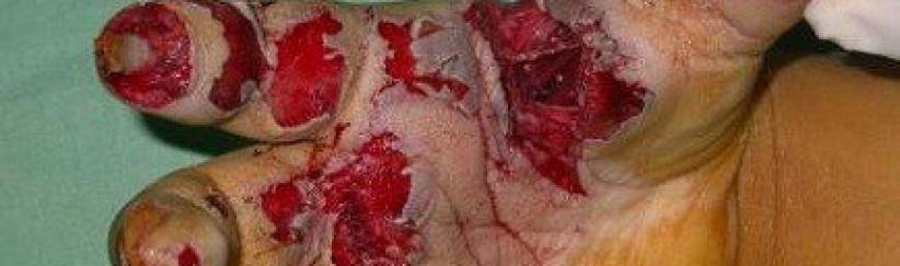 الصحة تدعو إلى عدم استخدام المفرقعات باحتفالات التوجيهي