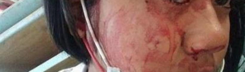 شابة تتعرق دماً... تعرّفوا على حالتها المرضية النادرة