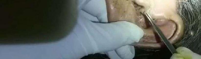 استخراج 30 يرقة حية من أذن مسنة!