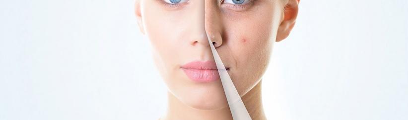 احذروا.. هذه الأطعمة تسبب “حب الشباب”