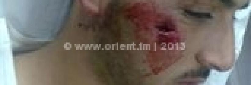 اصابة شاب برصاصة معدنية بوجهه في مواجهات بمخيم عايدة