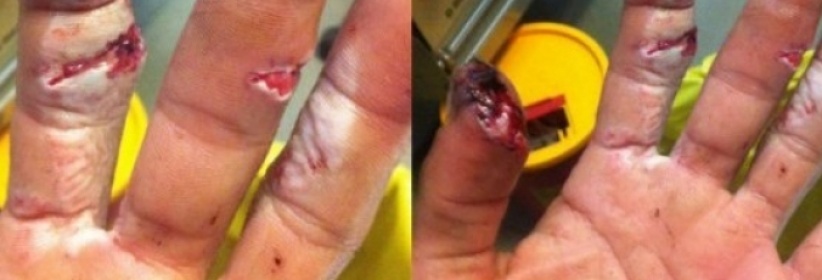 بسبب إضراب أطباء ‫‏مستشفى رفيديا‬ ضاع إصبعي