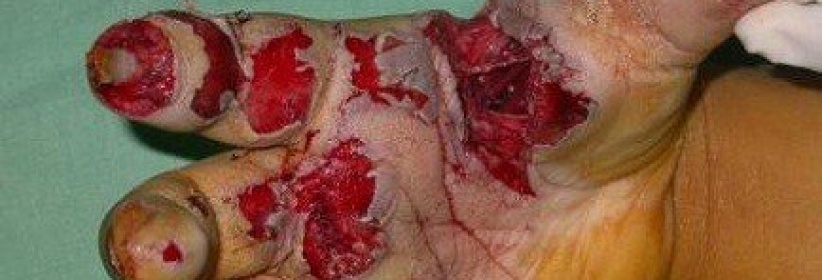 الصحة تدعو إلى عدم استخدام المفرقعات باحتفالات التوجيهي