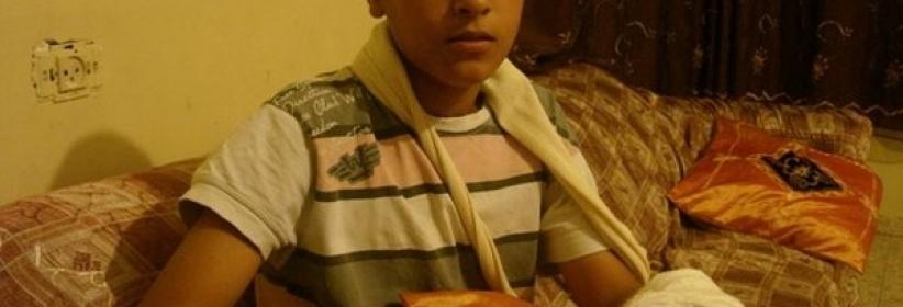 الجليل- بتر أصابع طفل كان يلهو بالمفرقعات