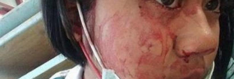 شابة تتعرق دماً... تعرّفوا على حالتها المرضية النادرة