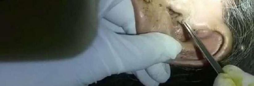 استخراج 30 يرقة حية من أذن مسنة!