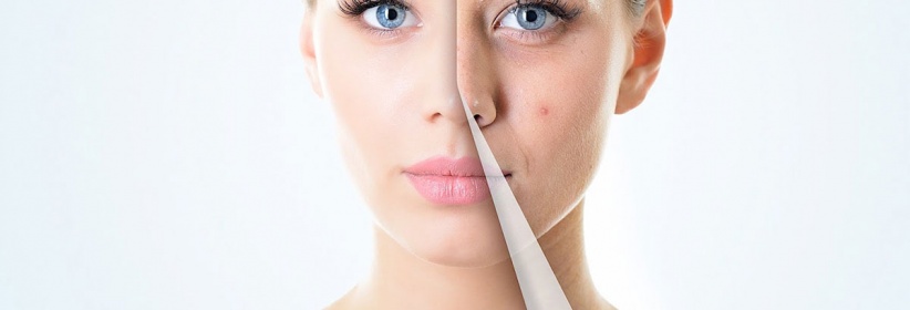 احذروا.. هذه الأطعمة تسبب “حب الشباب”